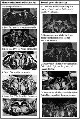 Assessing Fatty Infiltration of Paraspinal Muscles in Patients With Lumbar Spinal Stenosis: Goutallier Classification and Quantitative MRI Measurements